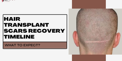 Hair Transplant Scars