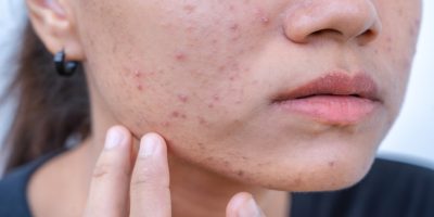 Woman with moderate to severe acne touching her cheek before acne facial Tysons Corner skincare session.