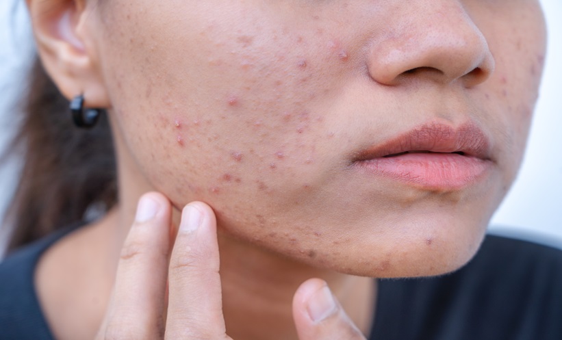 Woman with moderate to severe acne touching her cheek before acne facial Tysons Corner skincare session.