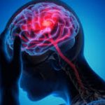 Find the Right Neurology Centre in Jaipur for Stroke and Nerve Care