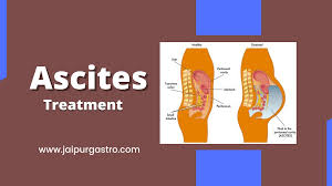 What Are the Latest Techniques Used for Ascites Treatment in Jaipur?